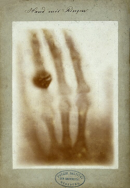 Historische Röntgenaufnahme der Hand von Anna Bertha Röntgen mit sichtbaren Fingerknochen und Ring, 1895