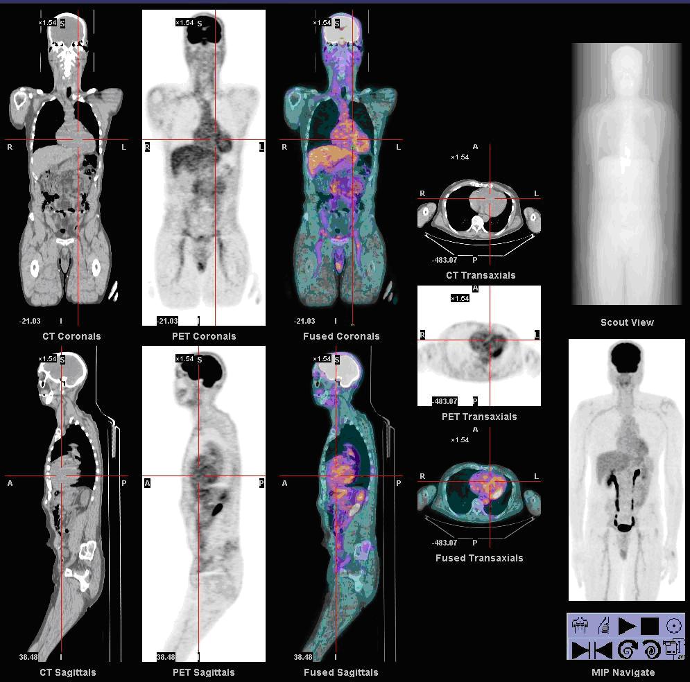 Ganzkörperaufnahme der Nuklearmedizin: CT, PET und kombinierte PET/CT im Vergleich